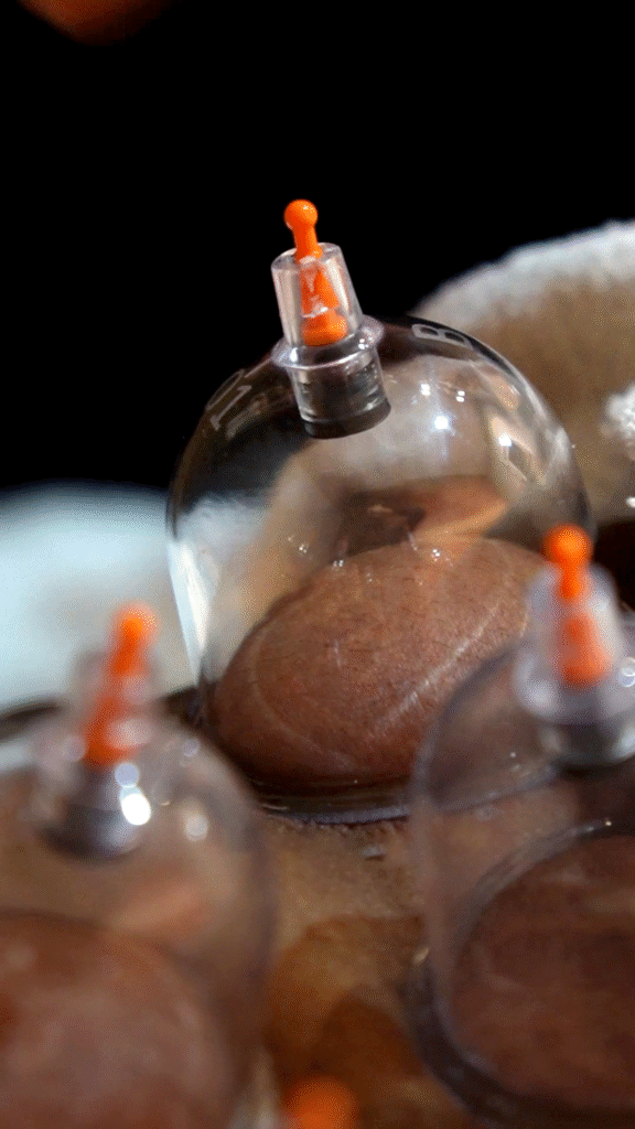 Cupping 1 cupping therapy