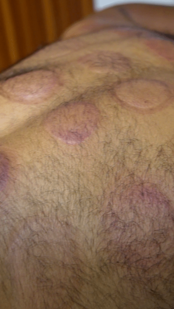 Cupping 2 Cupping therapy