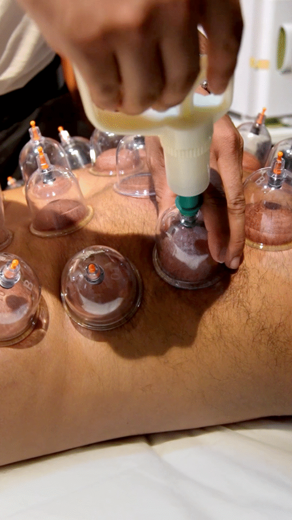 Cupping 3 cupping therapy